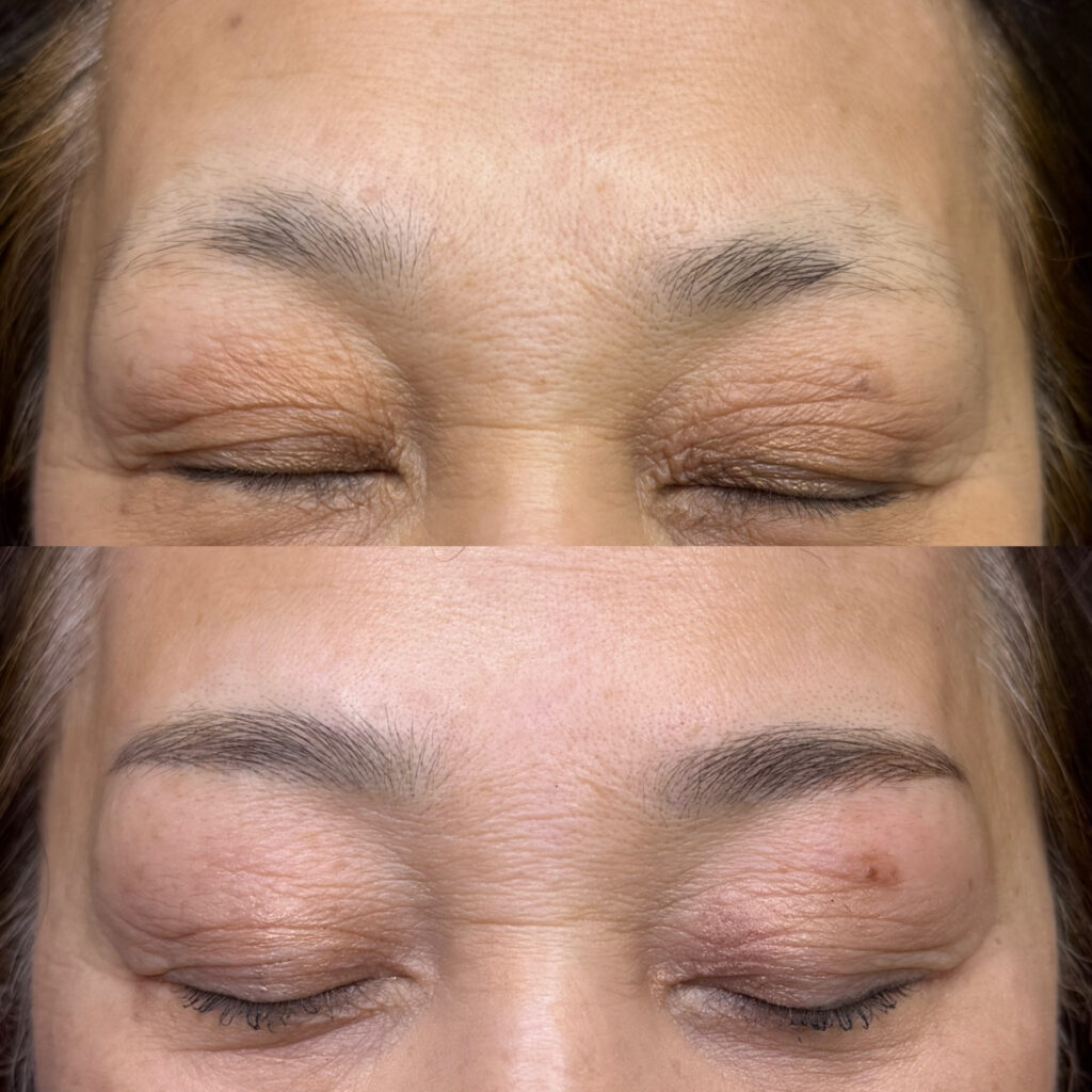 眉アートメイク(マシンヘアストローク)症例写真1